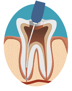 عصب کشی دندان به انگلیسی